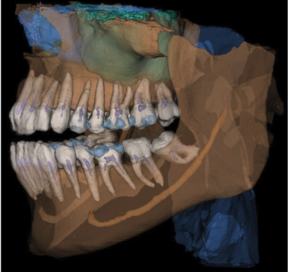 CBCT AI Segmentation
