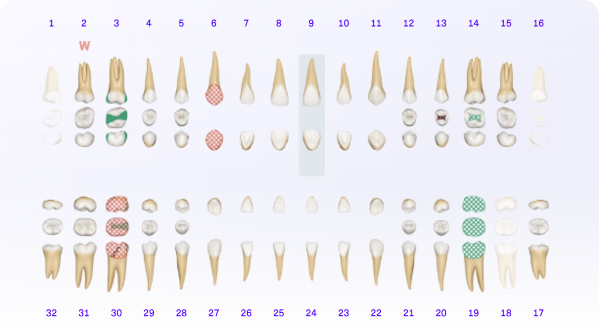Annotated odontogram showing hard tissue findings charted by Overjet Voice
